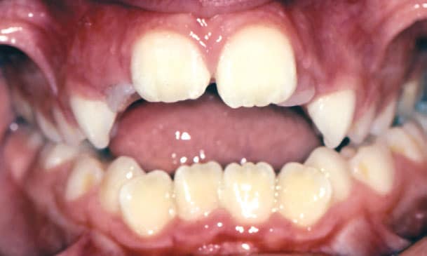 Open bite, where the upper and lower front teeth do not touch when the back teeth are closed