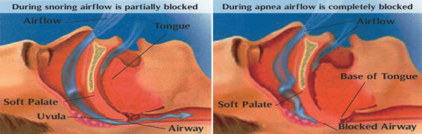 Illustration of a relaxed tongue and soft tissue blocking the airway during obstructive sleep apnea