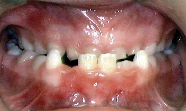 Child with an underbite, the lower teeth sitting in front of the upper front teeth